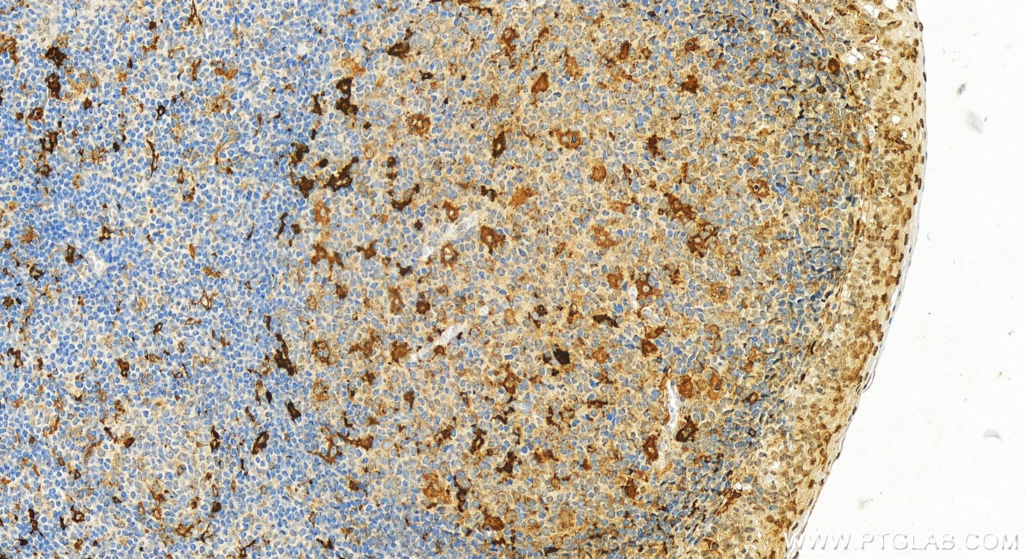 IHC staining of human tonsillitis using 32149-1-AP