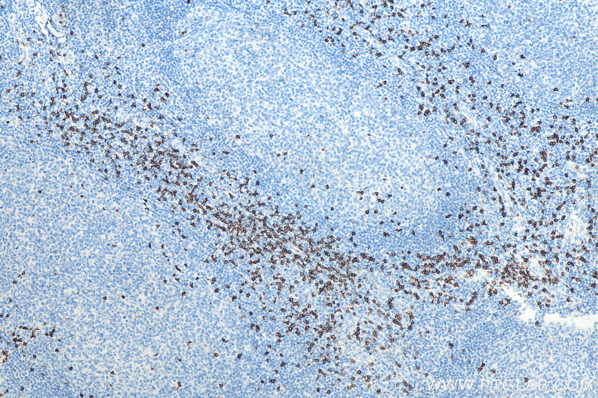 IHC staining of human tonsillitis using 66868-1-Ig