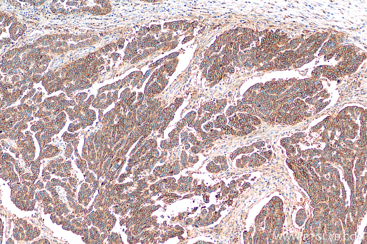 IHC staining of human ovary tumor using 60232-1-Ig