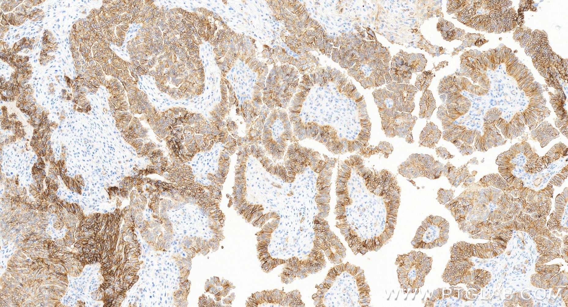 IHC staining of human ovary cancer using 84142-1-RR