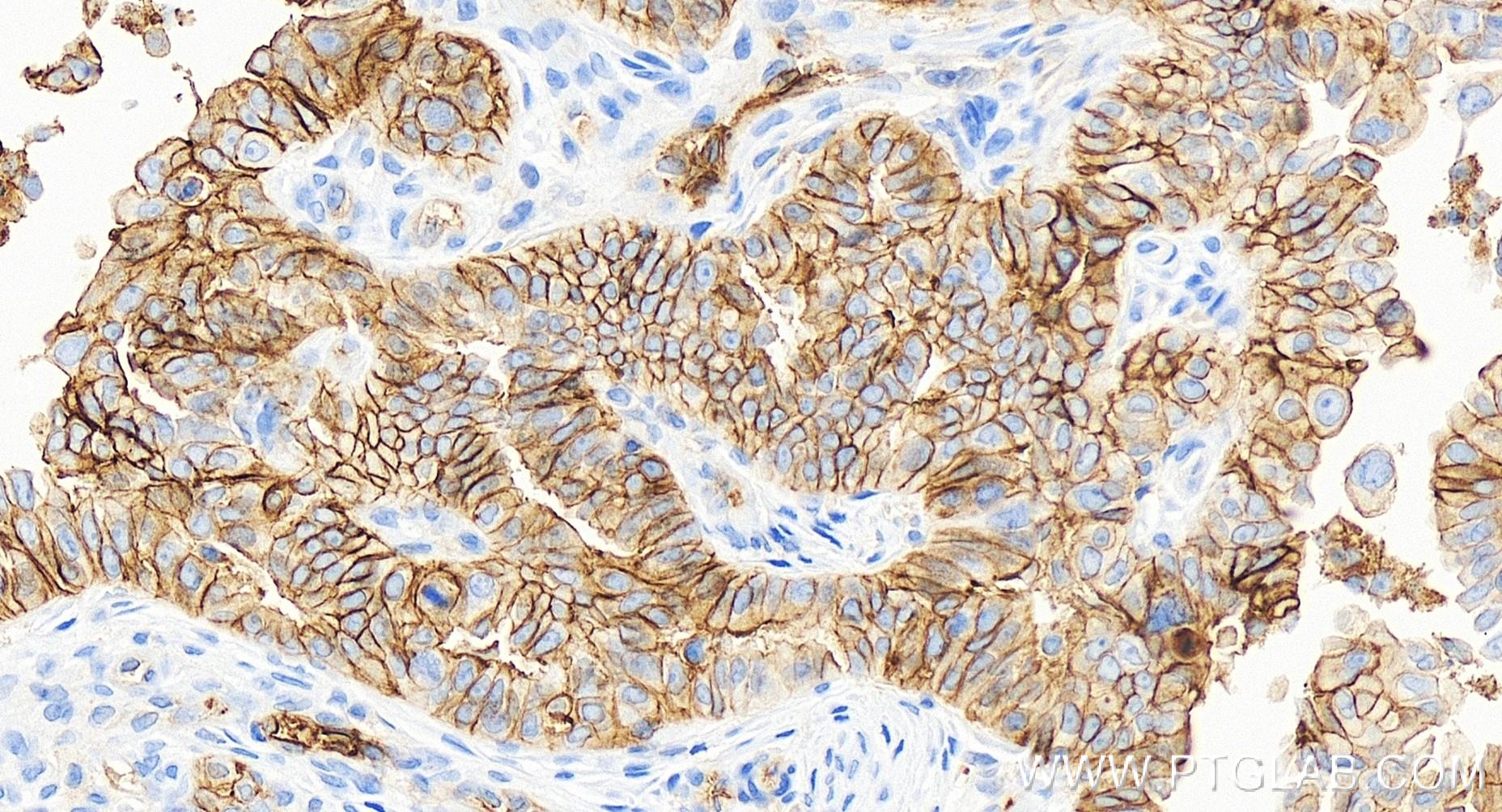 IHC staining of human ovary cancer using 84142-1-RR