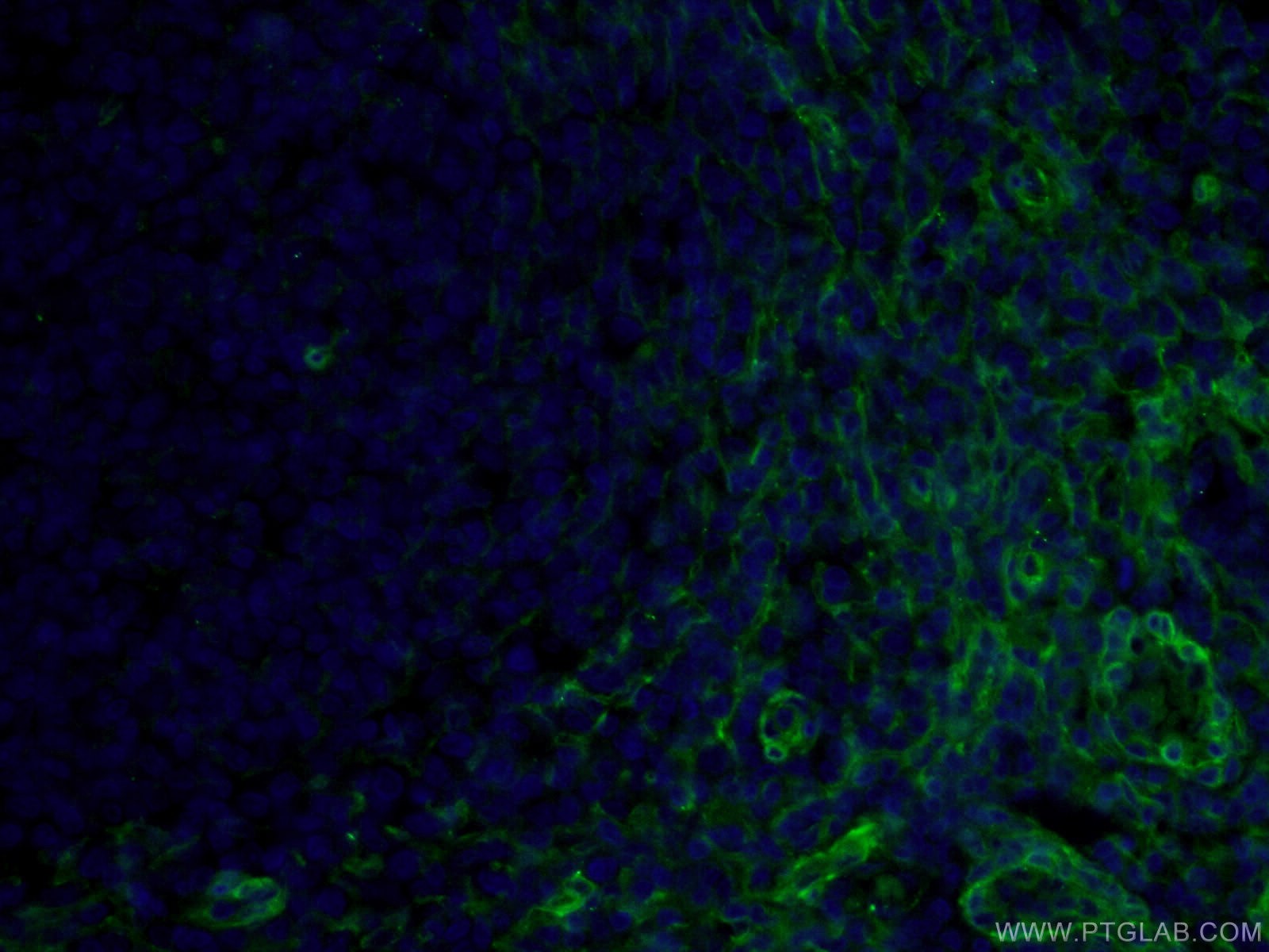 IF Staining of human tonsillitis using 66766-1-Ig