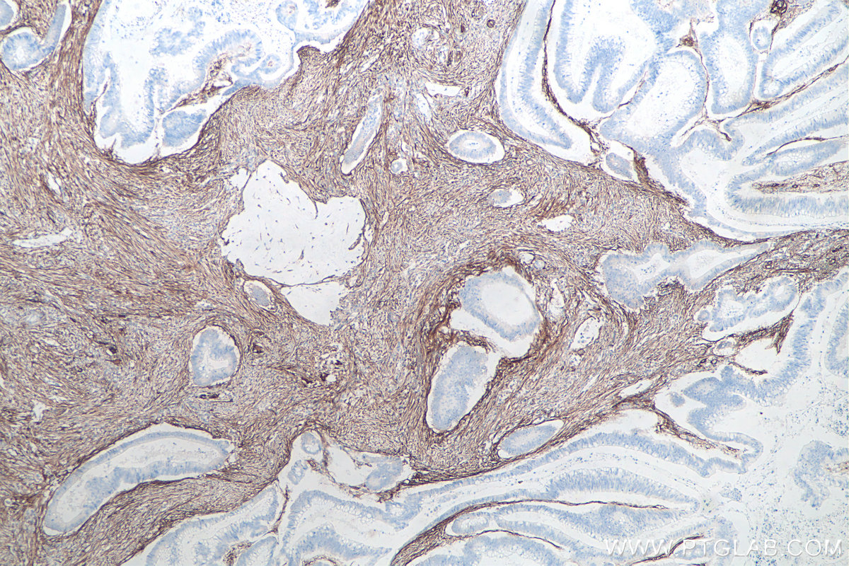 IHC staining of human colon cancer using 66766-1-Ig (same clone as 66766-1-PBS)