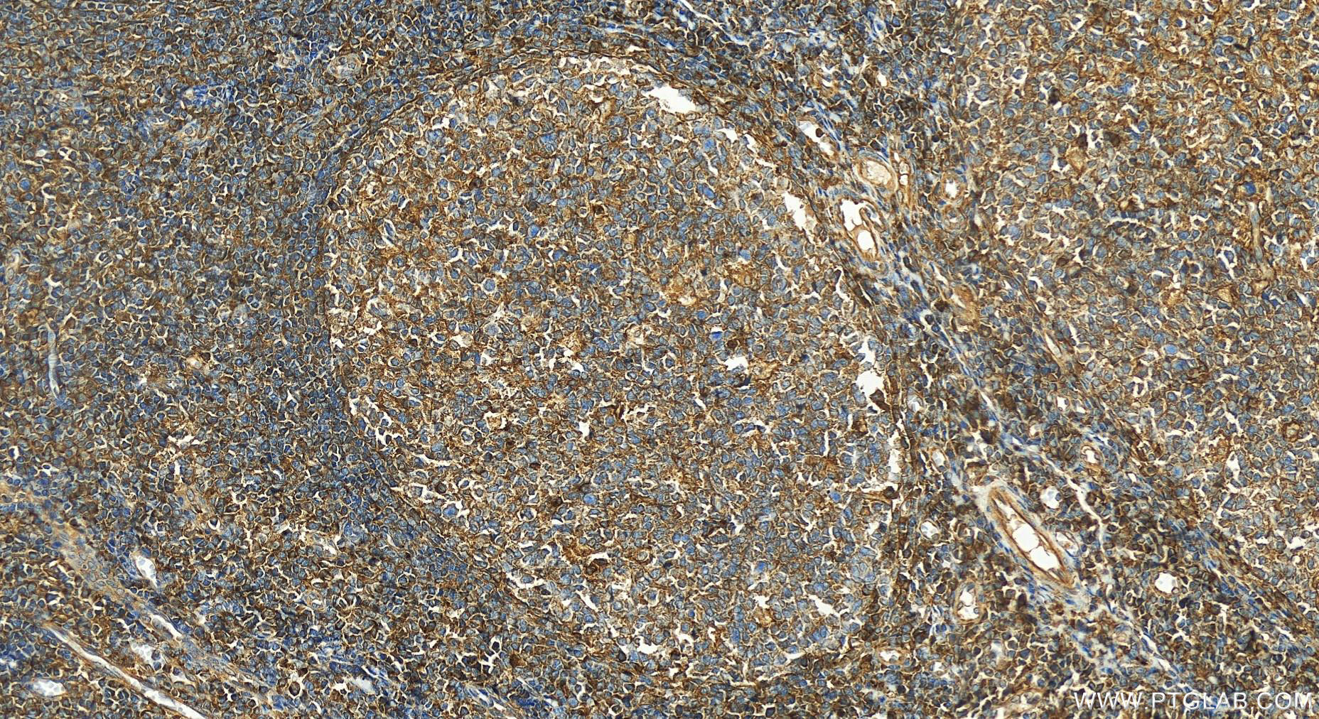 IHC staining of human tonsillitis using 13071-1-AP (same clone as 13071-1-PBS)