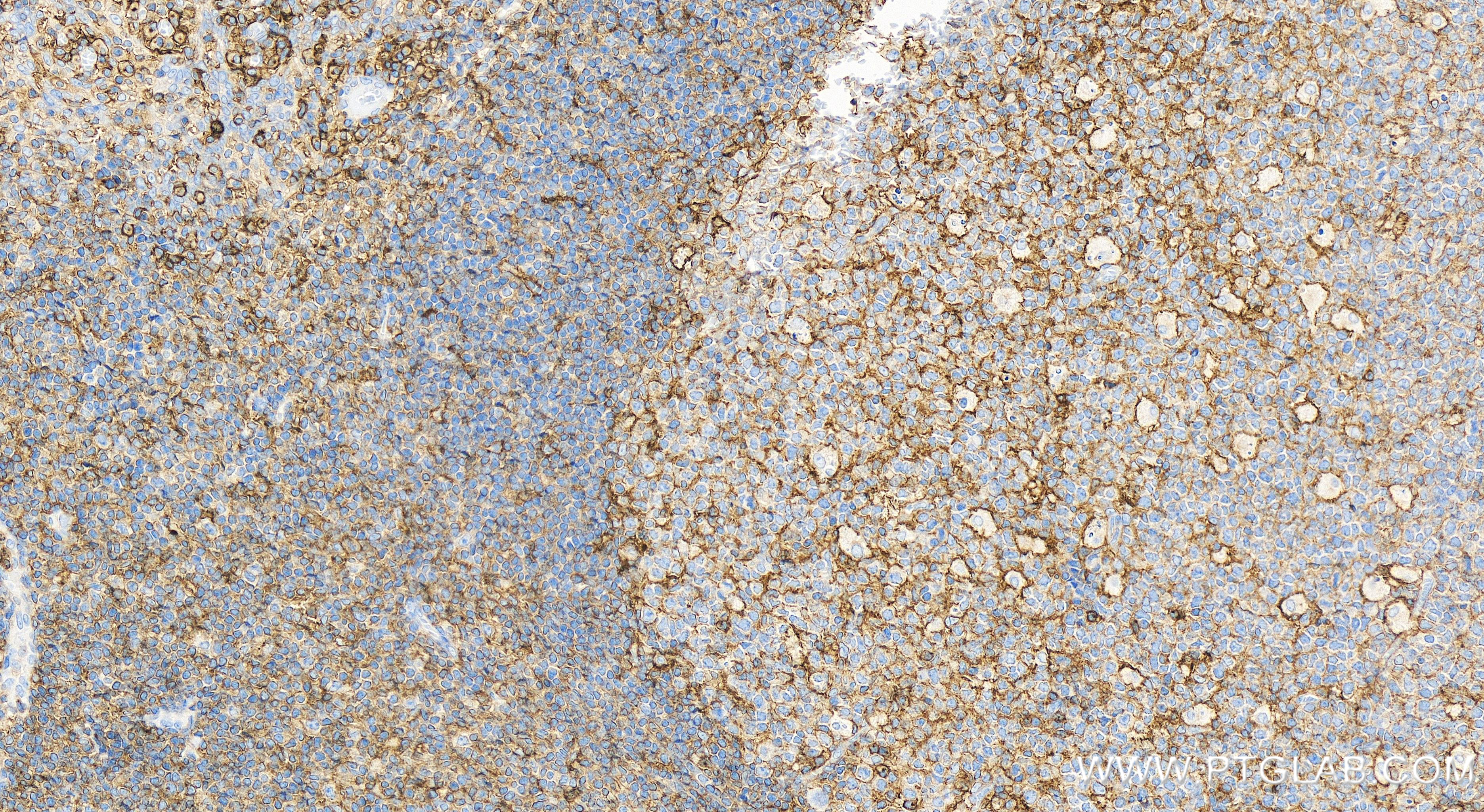 IHC staining of human tonsillitis using 84255-6-RR (same clone as 84255-6-PBS)