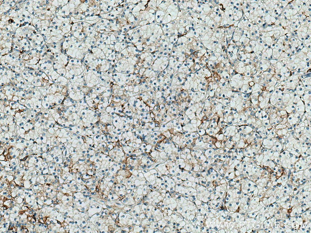 IHC staining of human renal cell carcinoma using 66883-1-Ig (same clone as 66883-1-PBS)