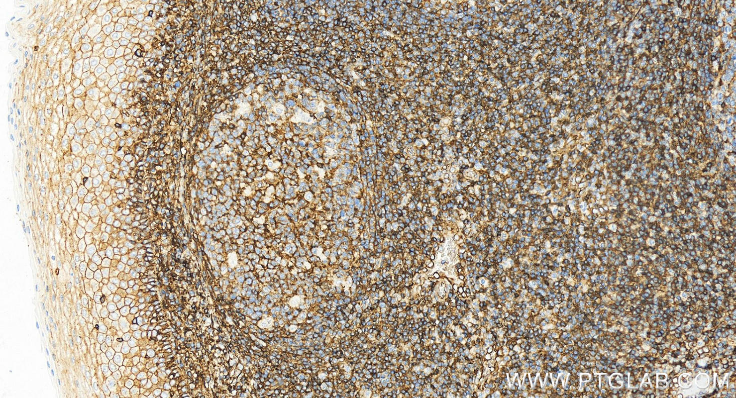 IHC staining of human tonsillitis using 84580-4-RR (same clone as 84580-4-PBS)