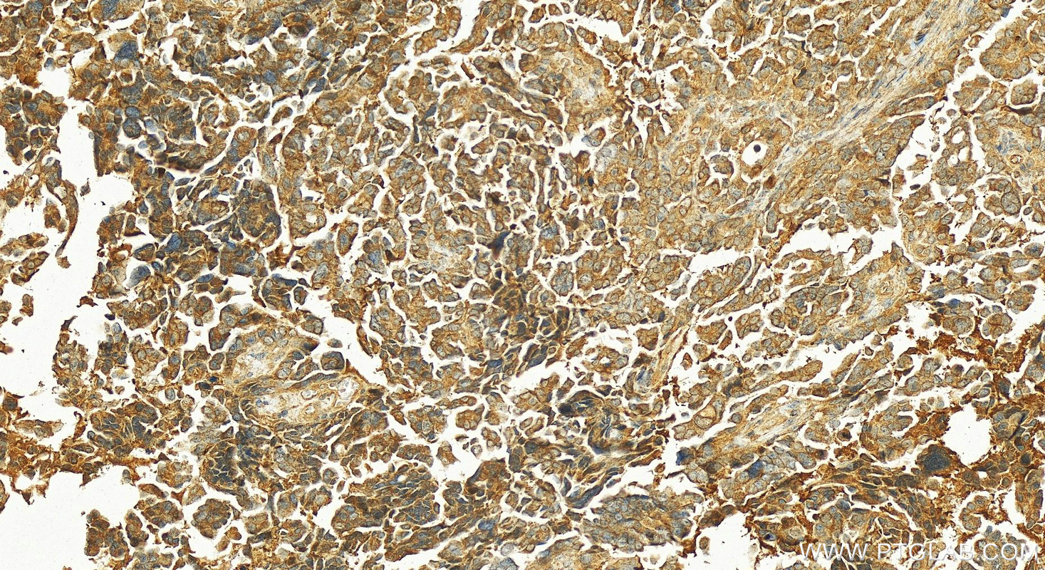 IHC staining of human ovary cancer using 28109-1-AP