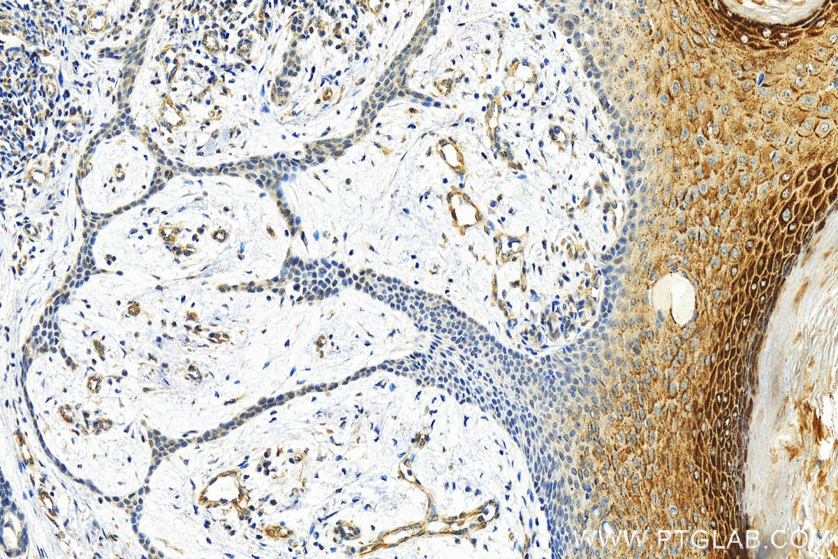 IHC staining of human skin cancer using 67145-1-Ig