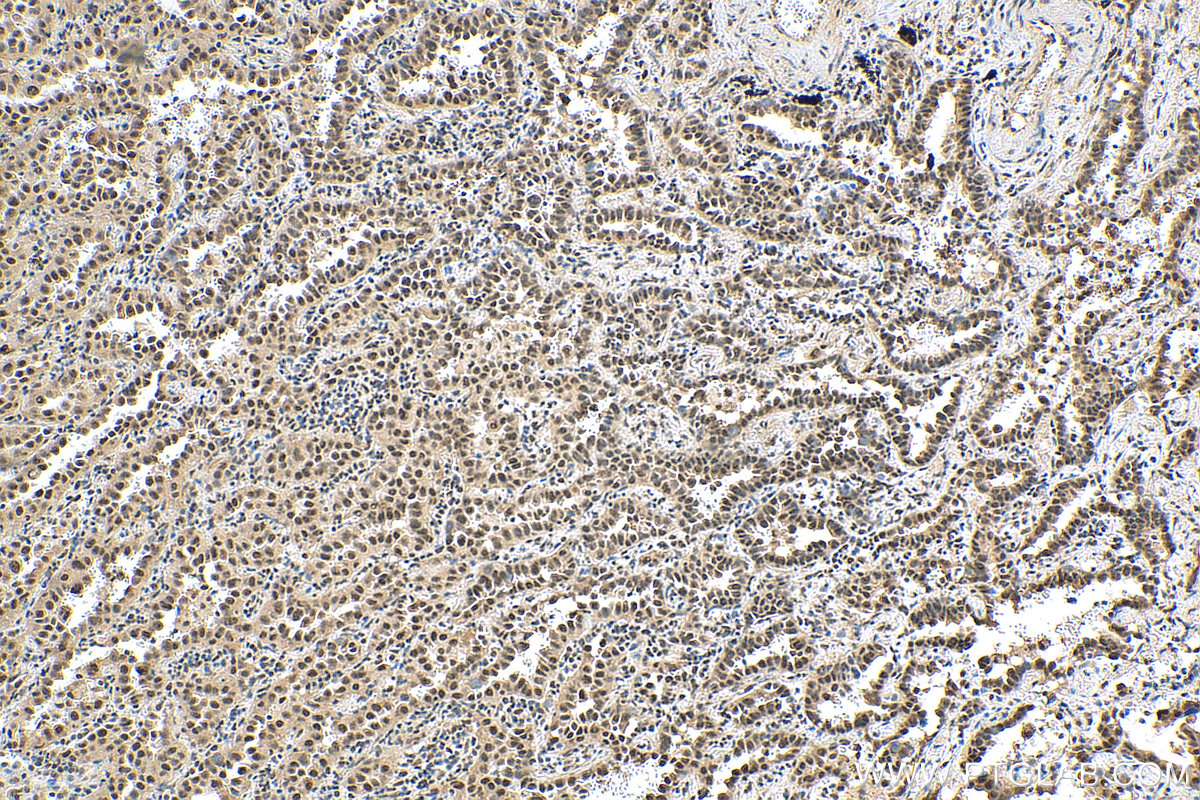 IHC staining of human lung cancer using 28613-1-AP