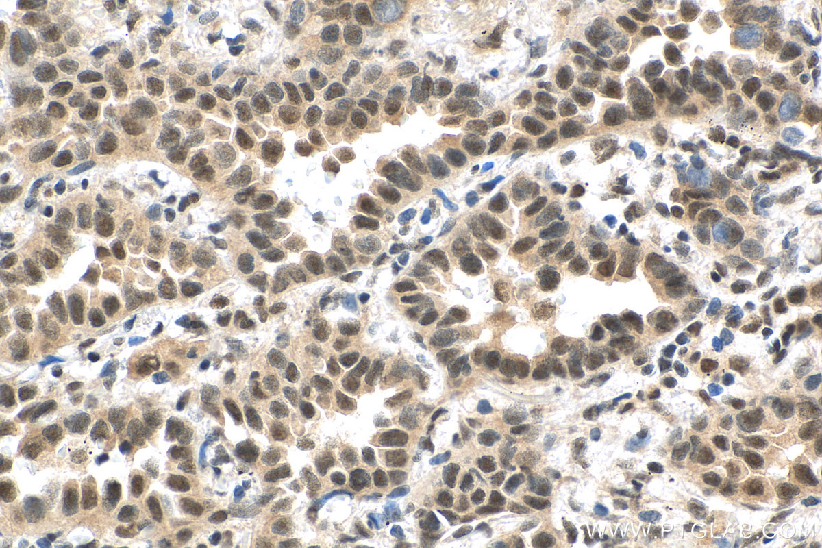 IHC staining of human lung cancer using 28613-1-AP