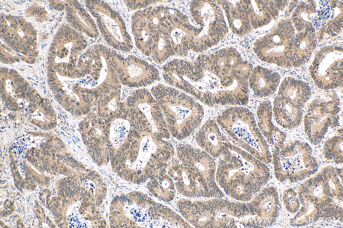 IHC staining of human colon cancer using 28613-1-AP