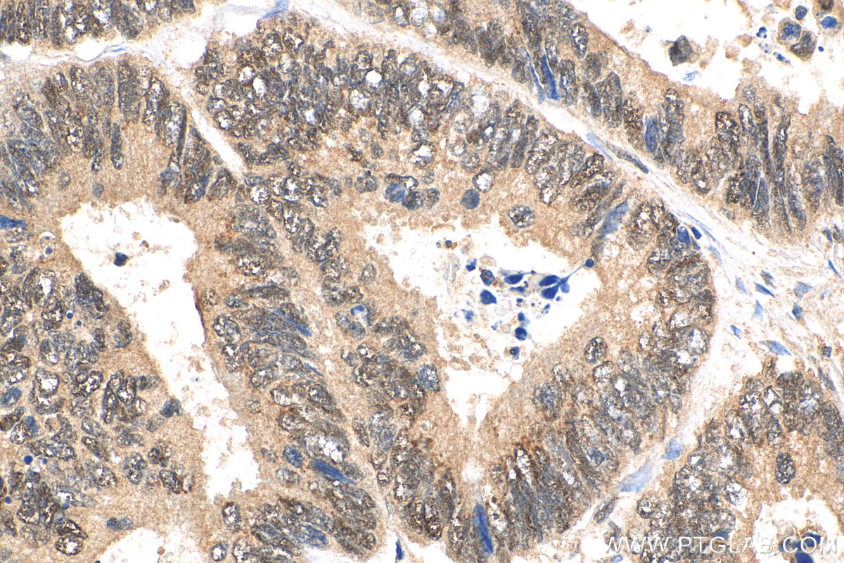 IHC staining of human colon cancer using 28613-1-AP