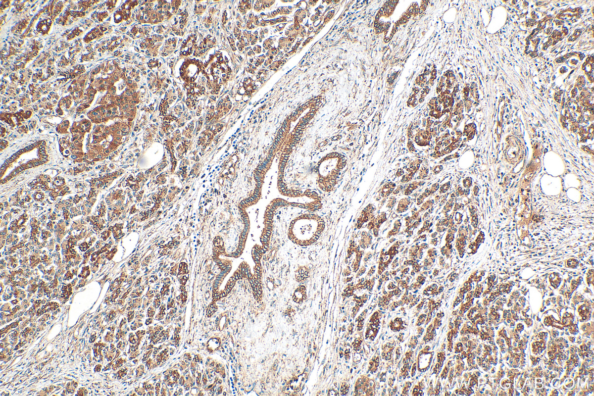 IHC staining of human pancreas cancer using 10155-1-AP