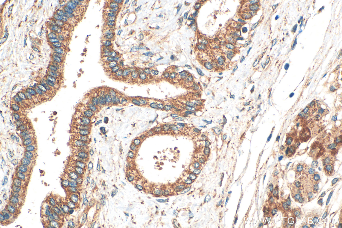 IHC staining of human pancreas cancer using 10155-1-AP