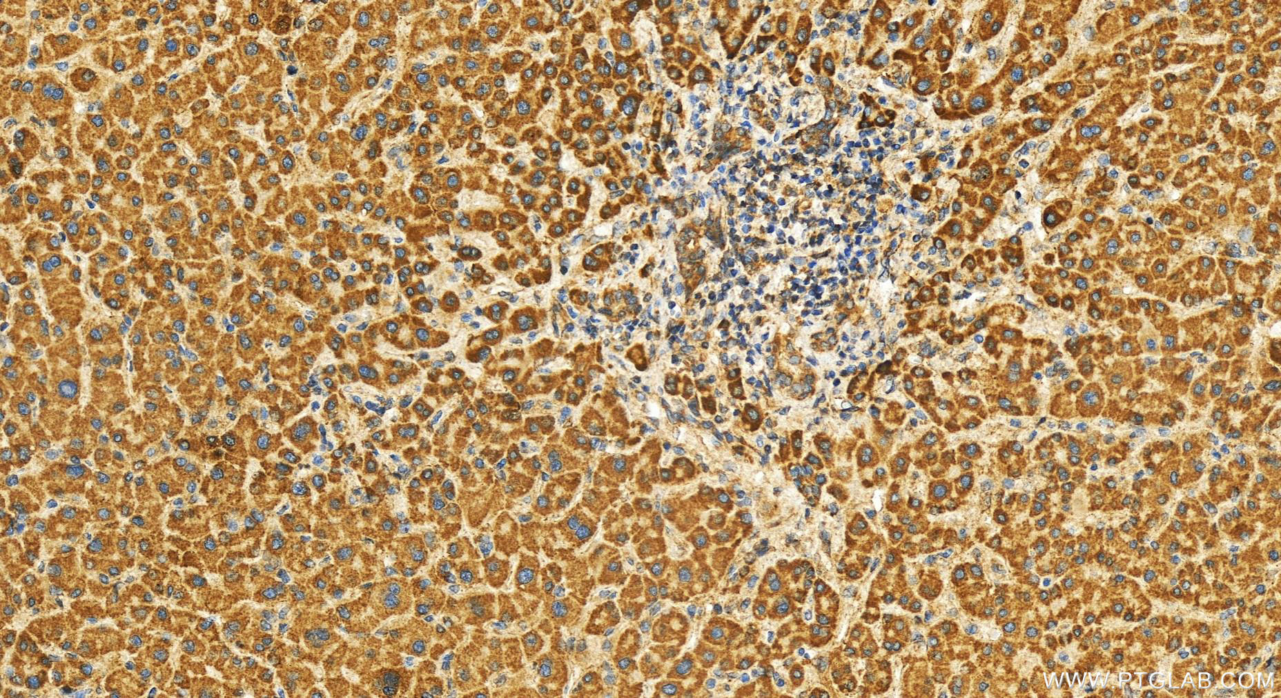 IHC staining of human intrahepatic cholangiocarcinoma using 19262-1-AP