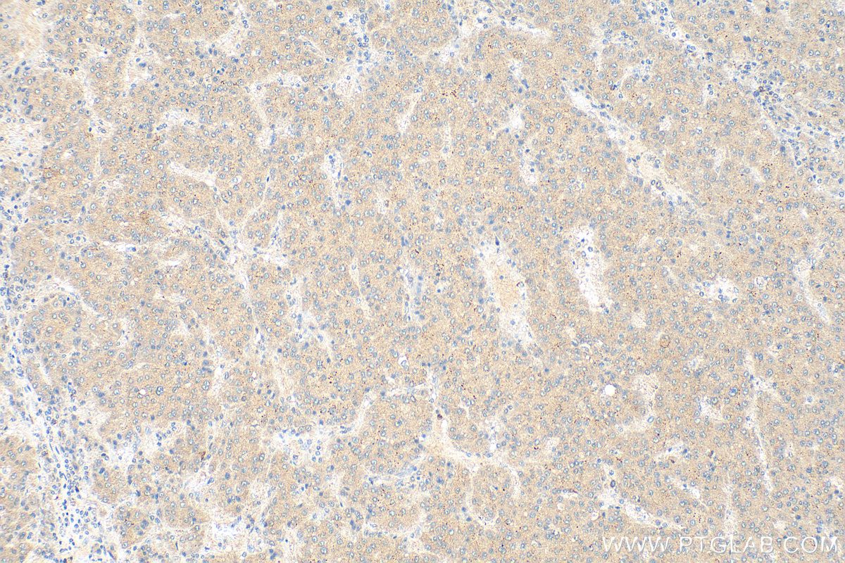 IHC staining of human liver cancer using 15594-1-AP