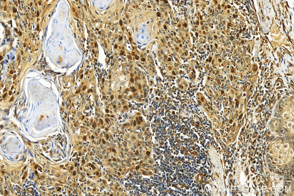 IHC staining of human skin cancer using 29316-1-AP