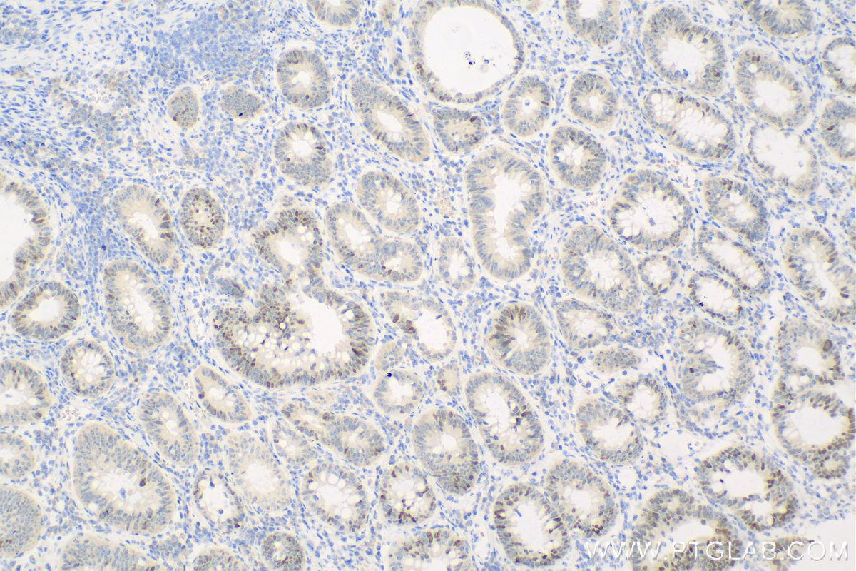 IHC staining of human colon cancer using 15249-1-AP