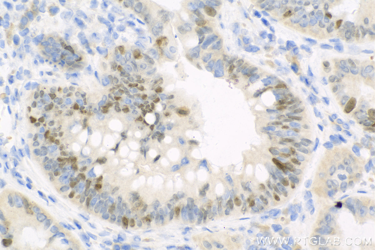 IHC staining of human colon cancer using 15249-1-AP