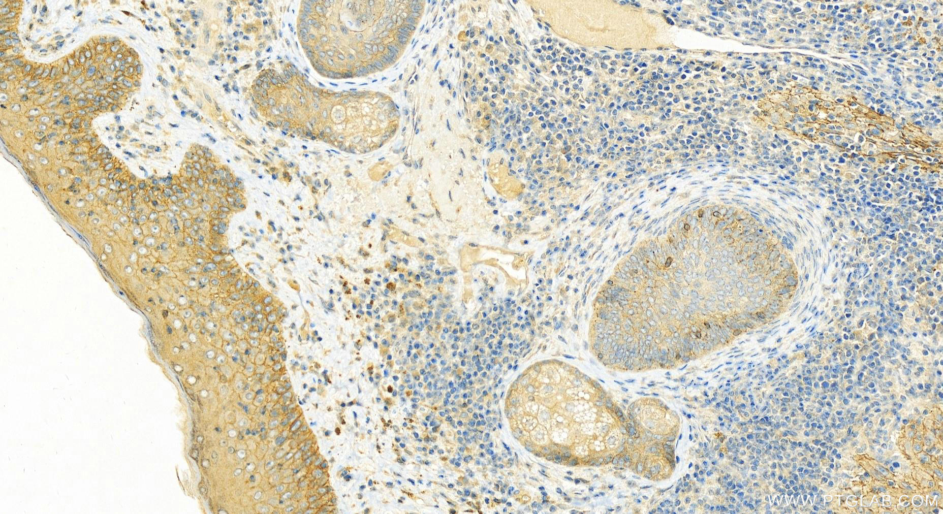 IHC staining of human skin cancer using 12754-1-AP