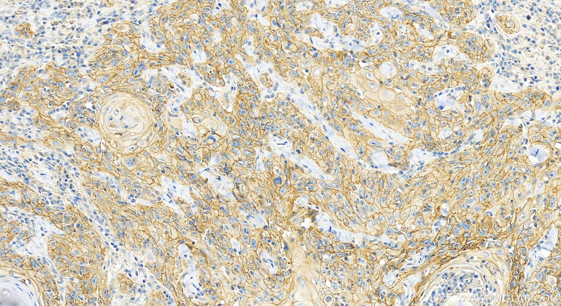 IHC staining of human skin cancer using 12754-1-AP