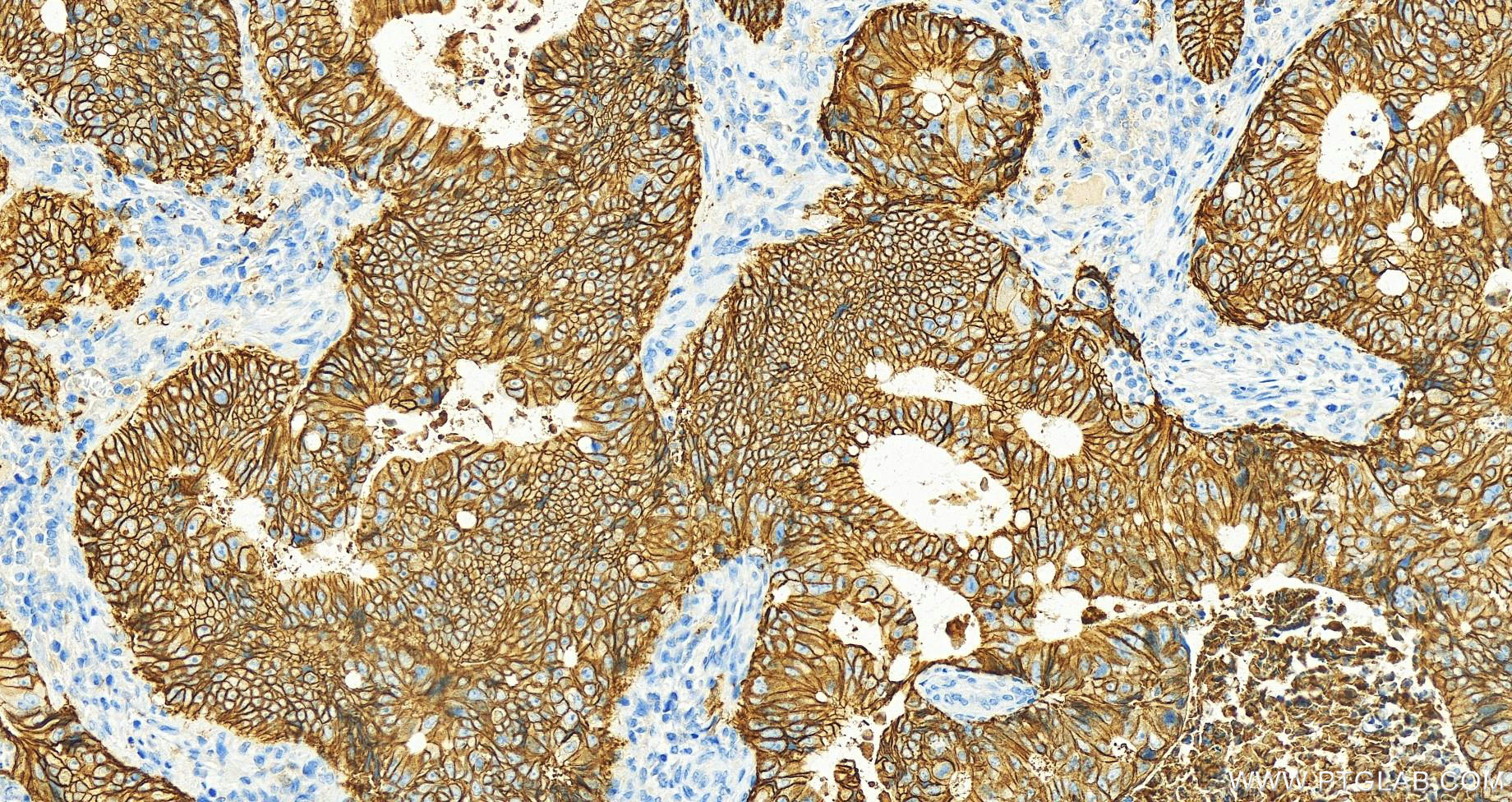 IHC staining of human colon cancer using 60351-1-Ig