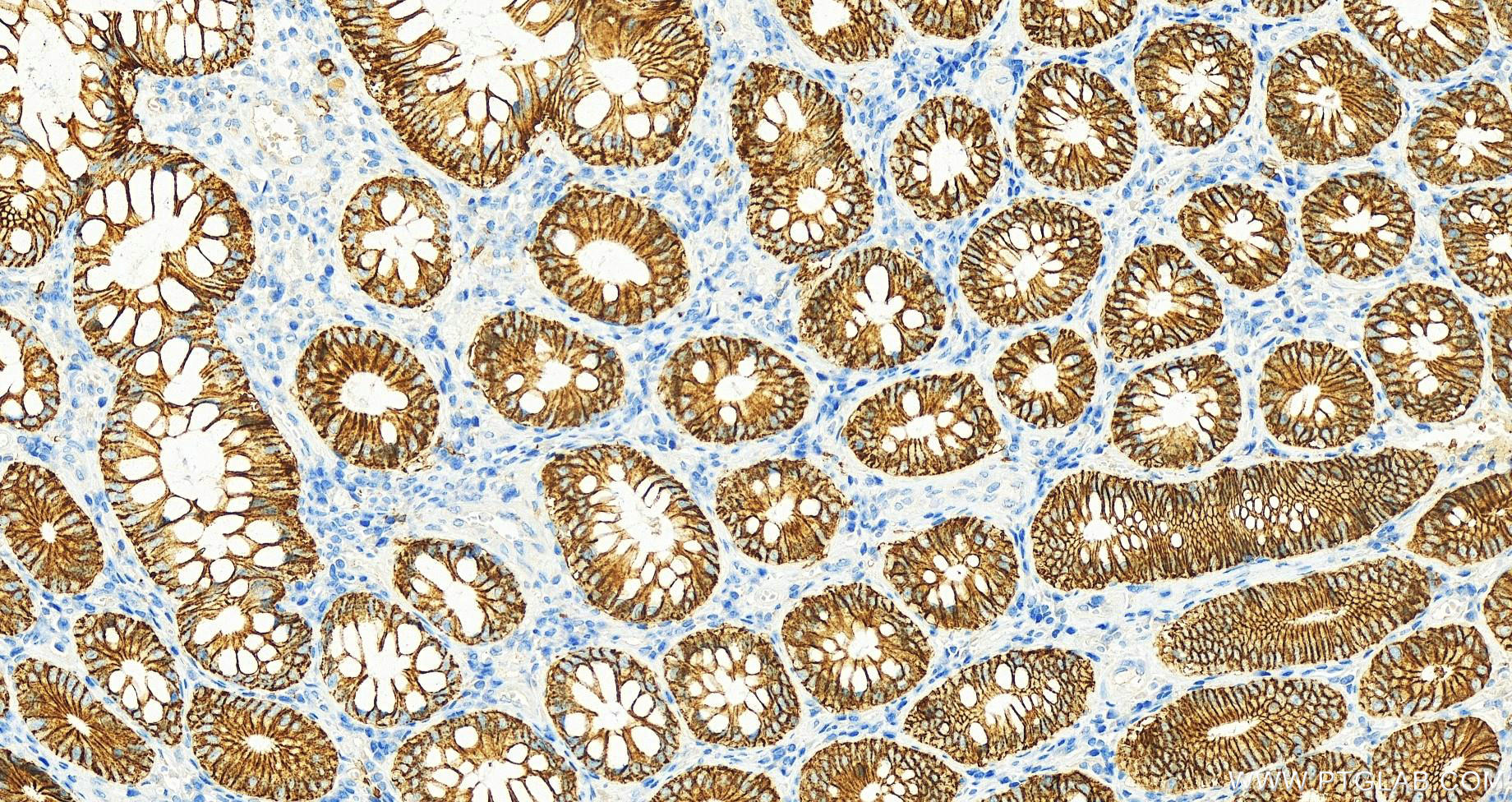 IHC staining of human colon cancer using 60351-1-Ig