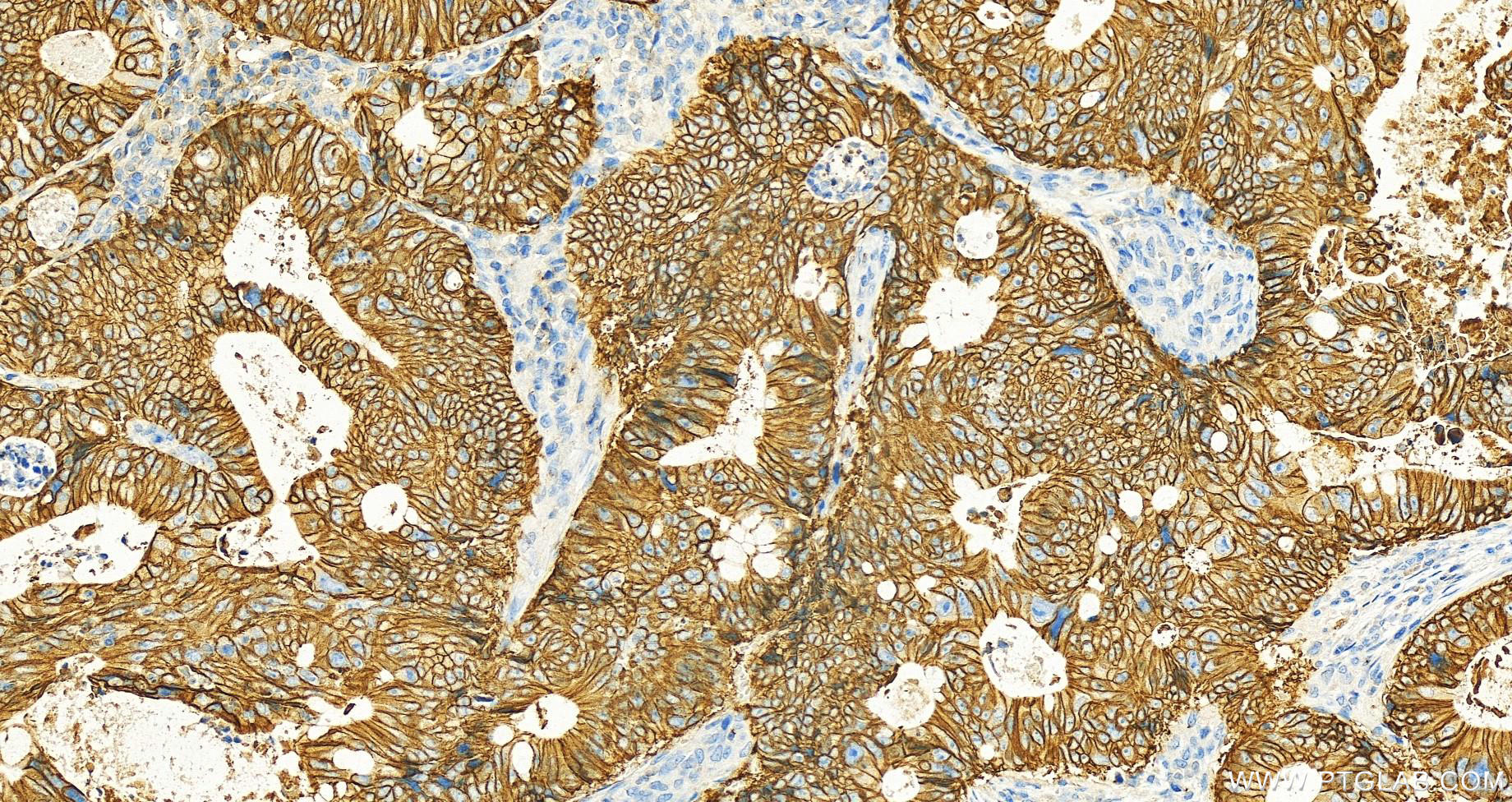 IHC staining of human colon cancer using 60351-1-Ig