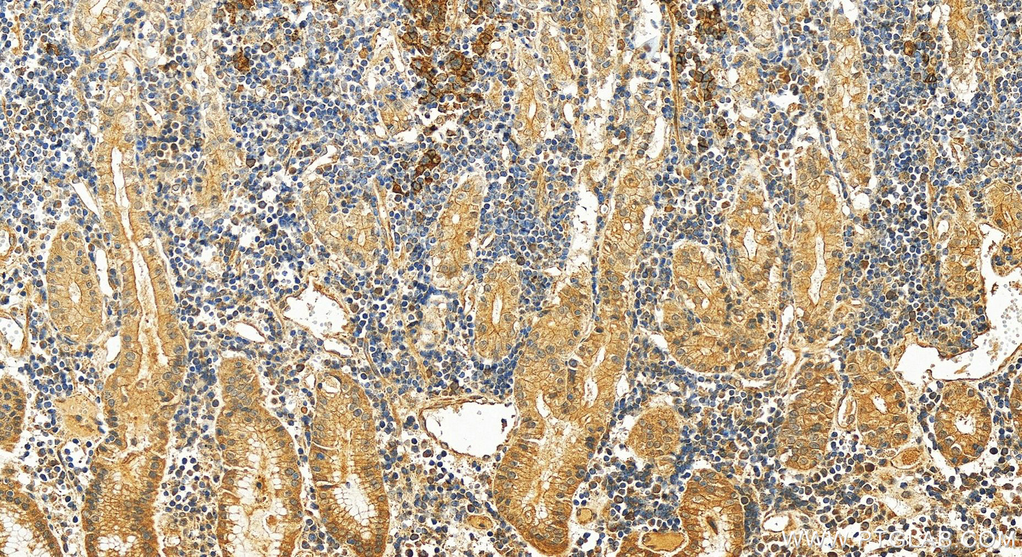 IHC staining of human stomach cancer using 13773-1-AP