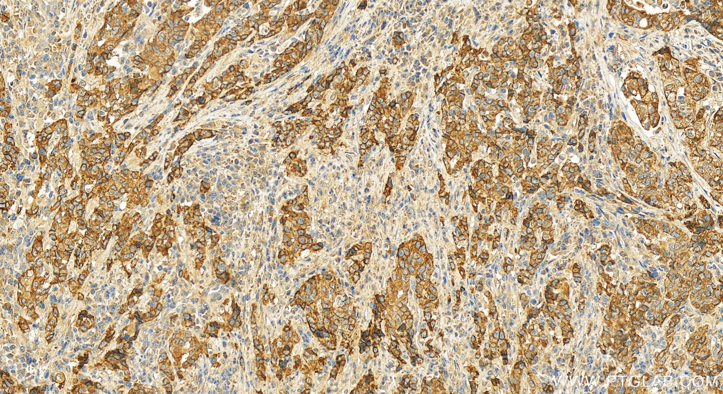 IHC staining of human stomach cancer using 13773-1-AP