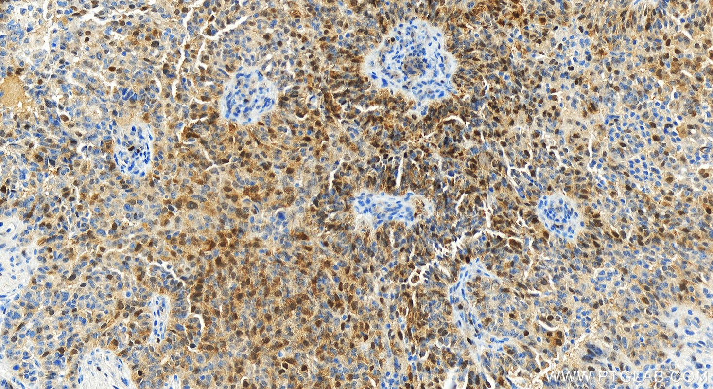 IHC staining of human ovarian  cancer using 83635-2-RR