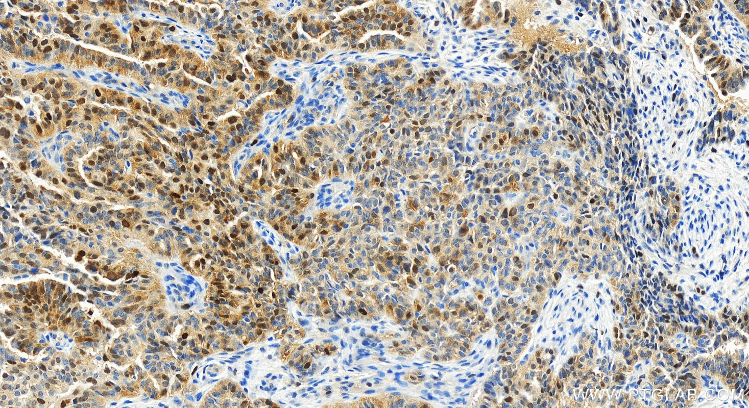 IHC staining of human ovarian  cancer using 83635-2-RR