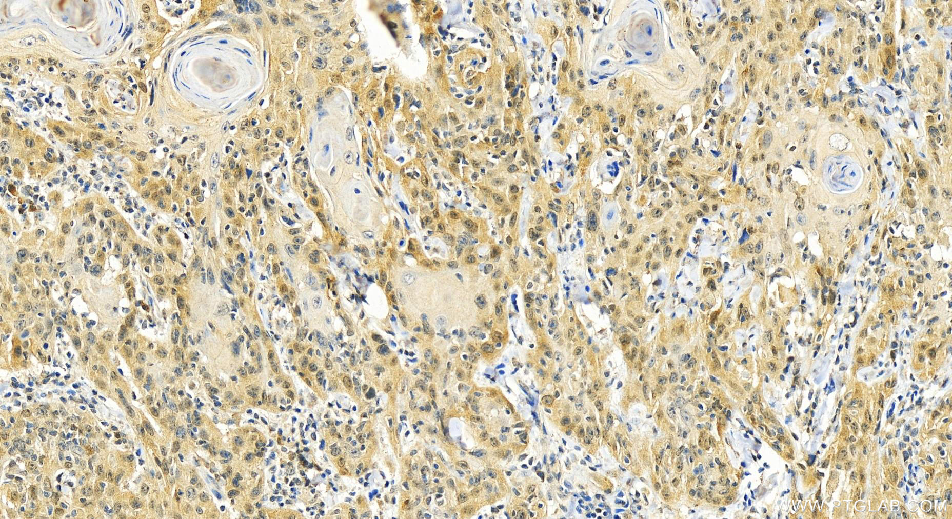 IHC staining of human skin cancer using 66278-1-Ig