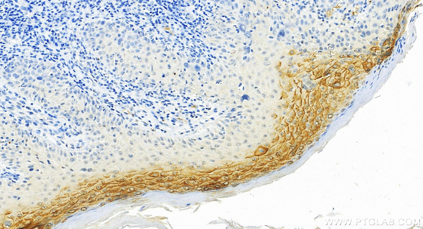 IHC staining of human brown disease using 27953-1-AP