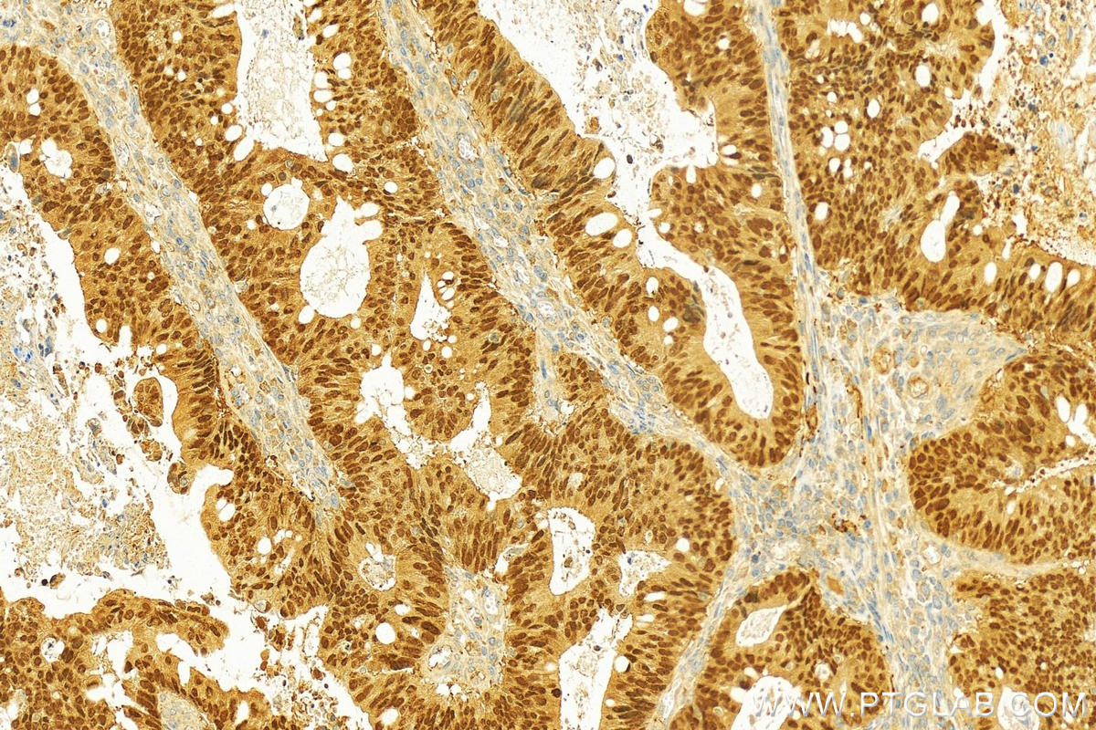 IHC staining of human colon cancer using 21655-1-AP