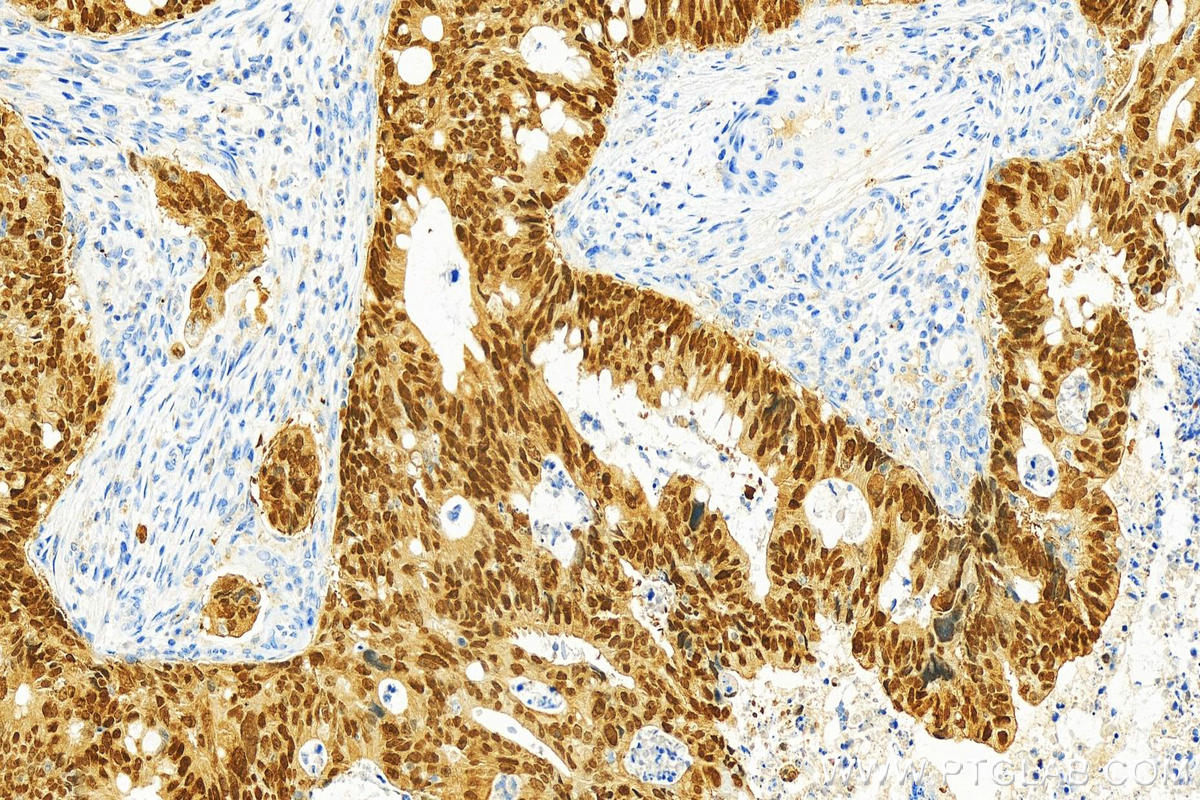 IHC staining of human colon cancer using 30380-1-AP