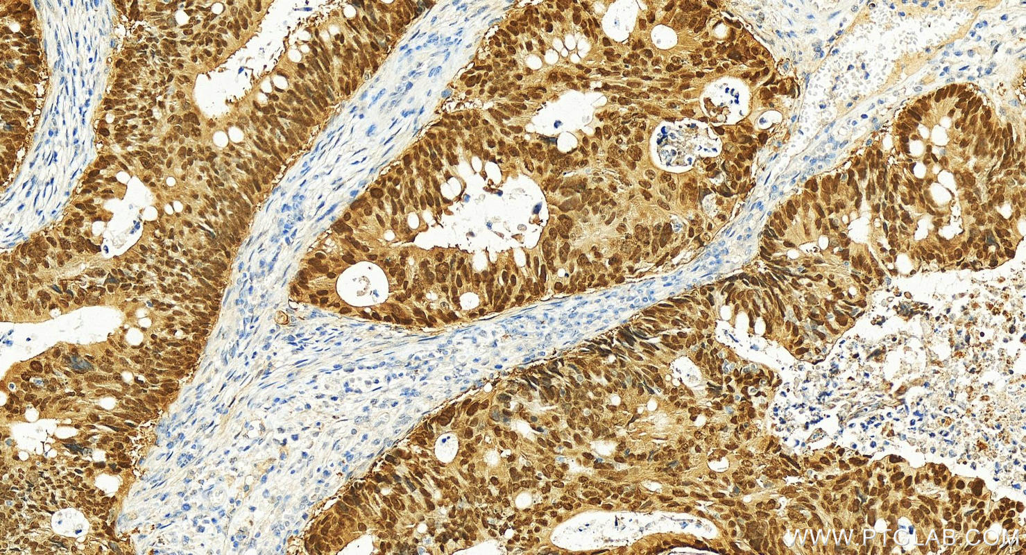 IHC staining of human colon cancer using 82659-1-RR