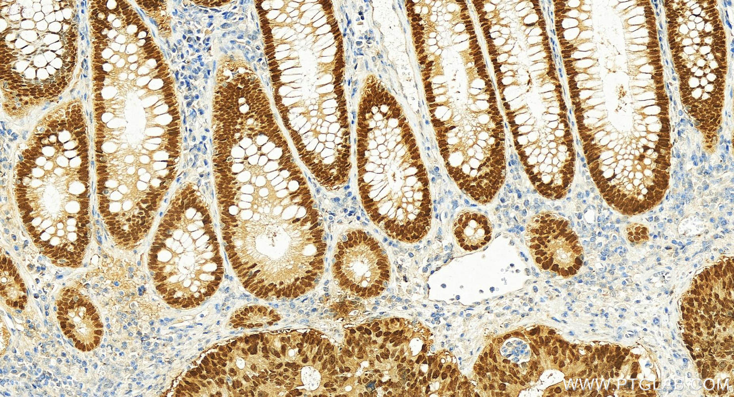 IHC staining of human colon cancer using 82659-1-RR