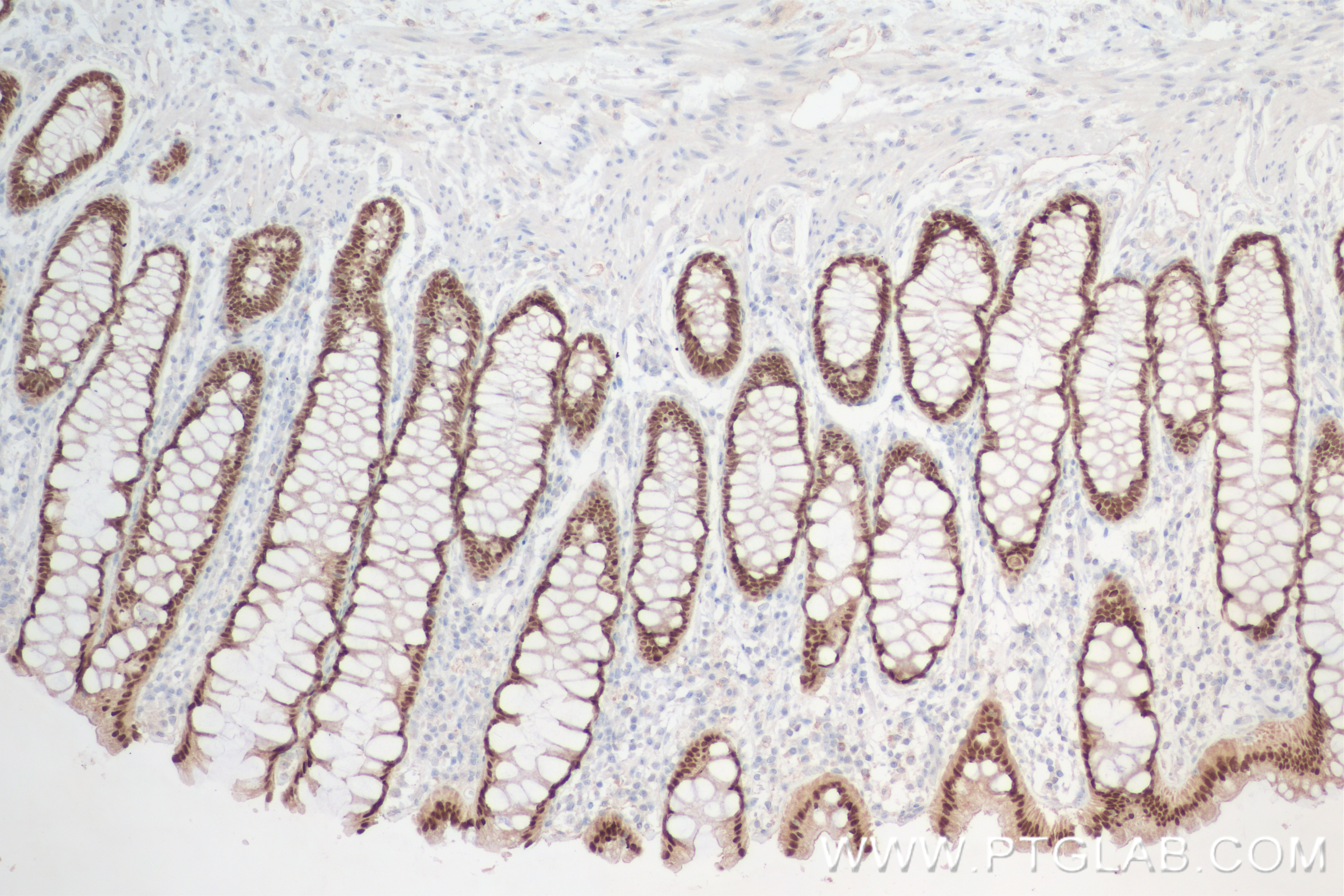 IHC staining of human rectal cancer using 82659-1-RR