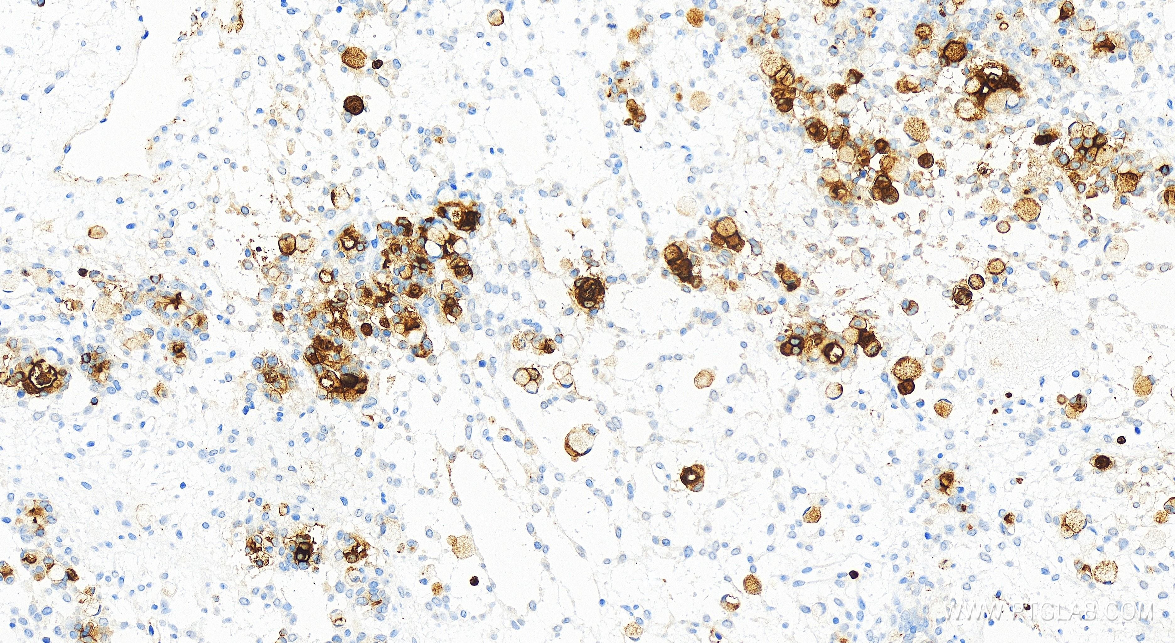 IHC staining of human ovary cancer using 83653-5-RR