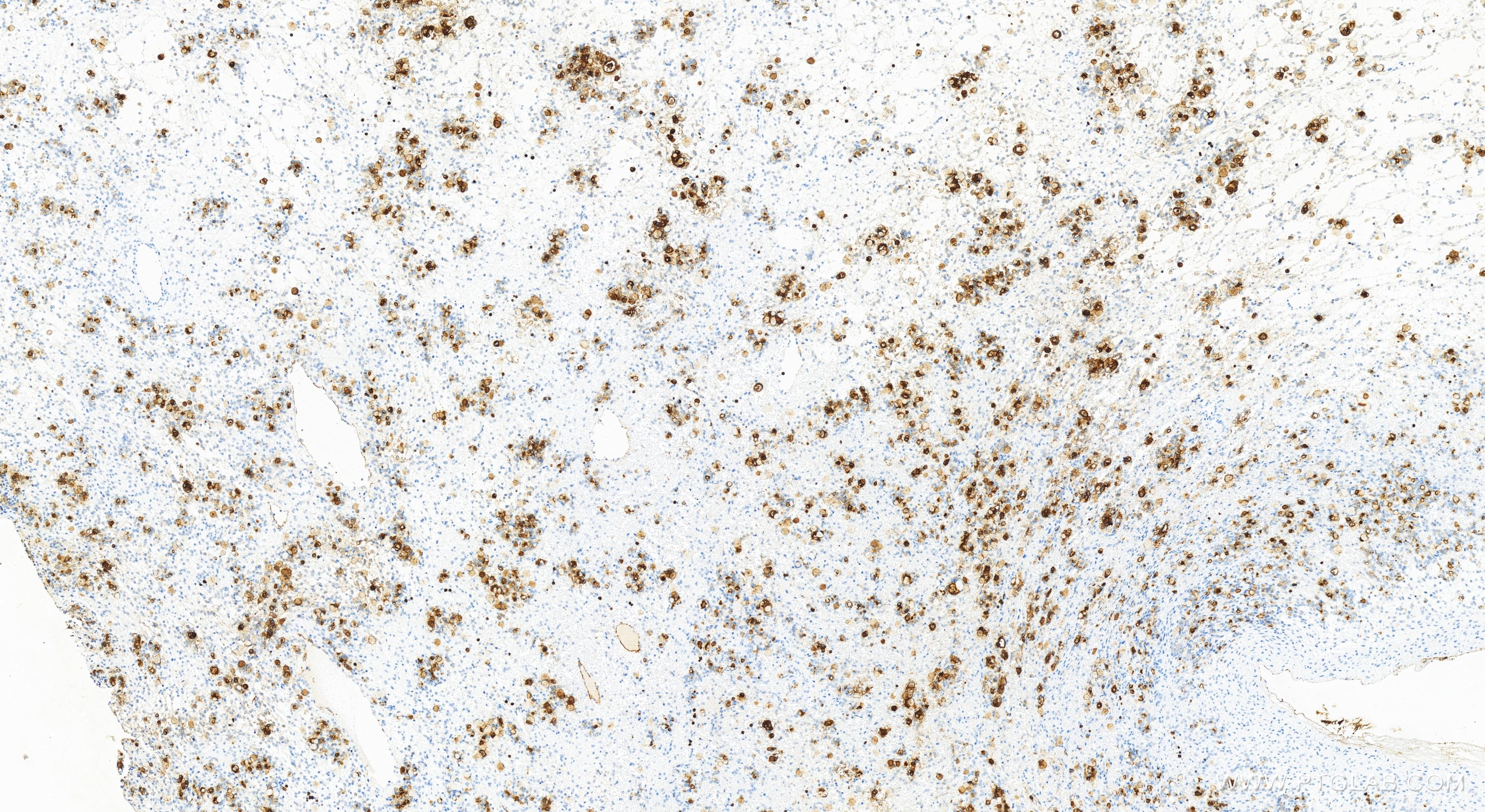 IHC staining of human ovary cancer using 83653-5-RR