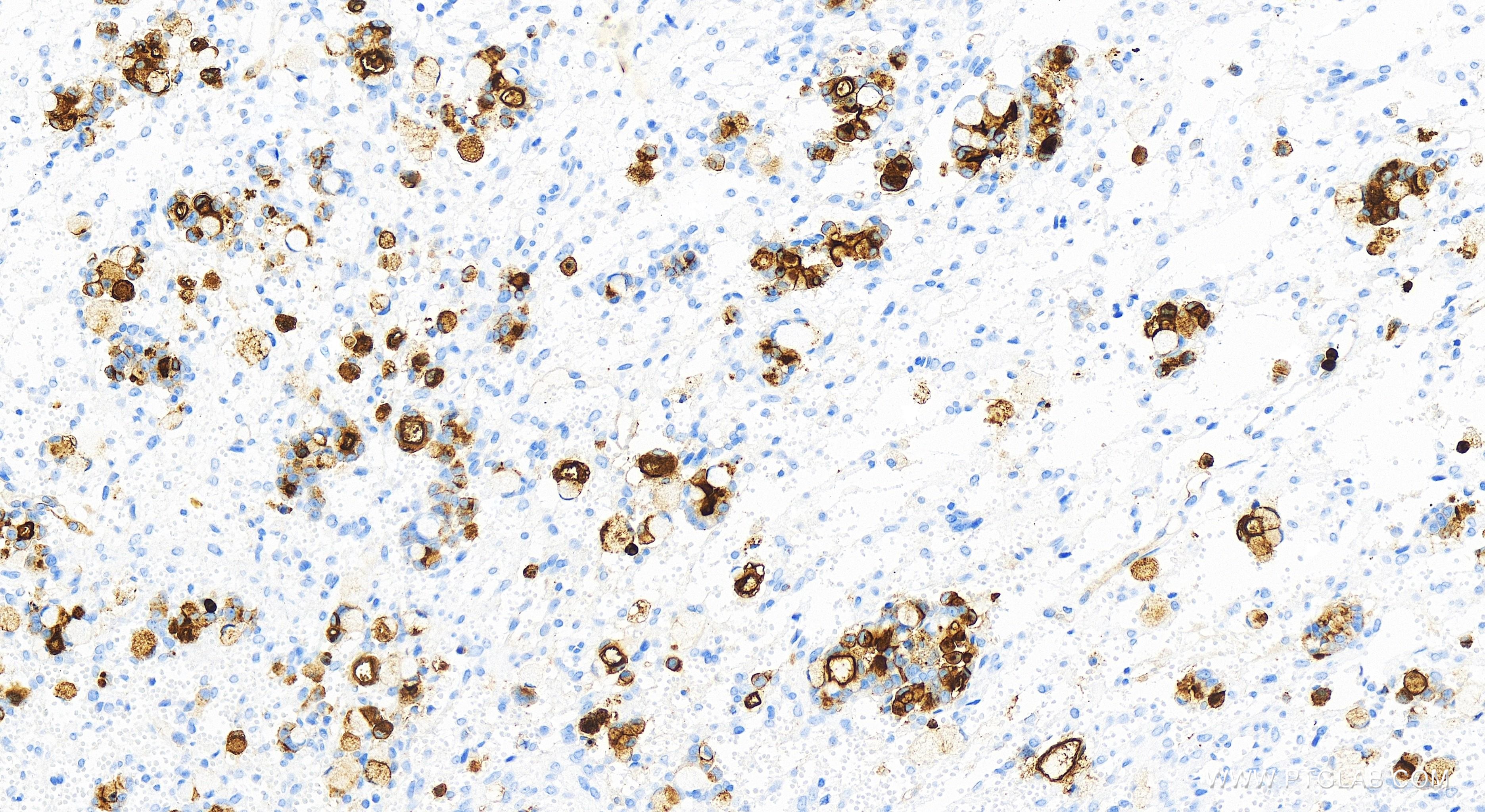 IHC staining of human ovary cancer using 83524-3-RR