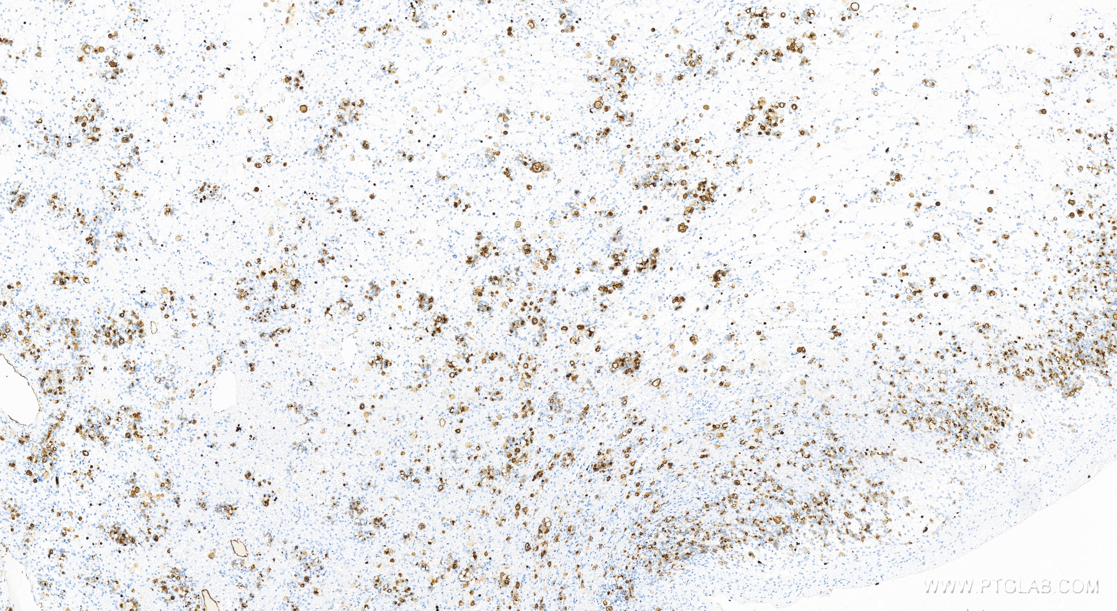 IHC staining of human ovary cancer using 83524-3-RR