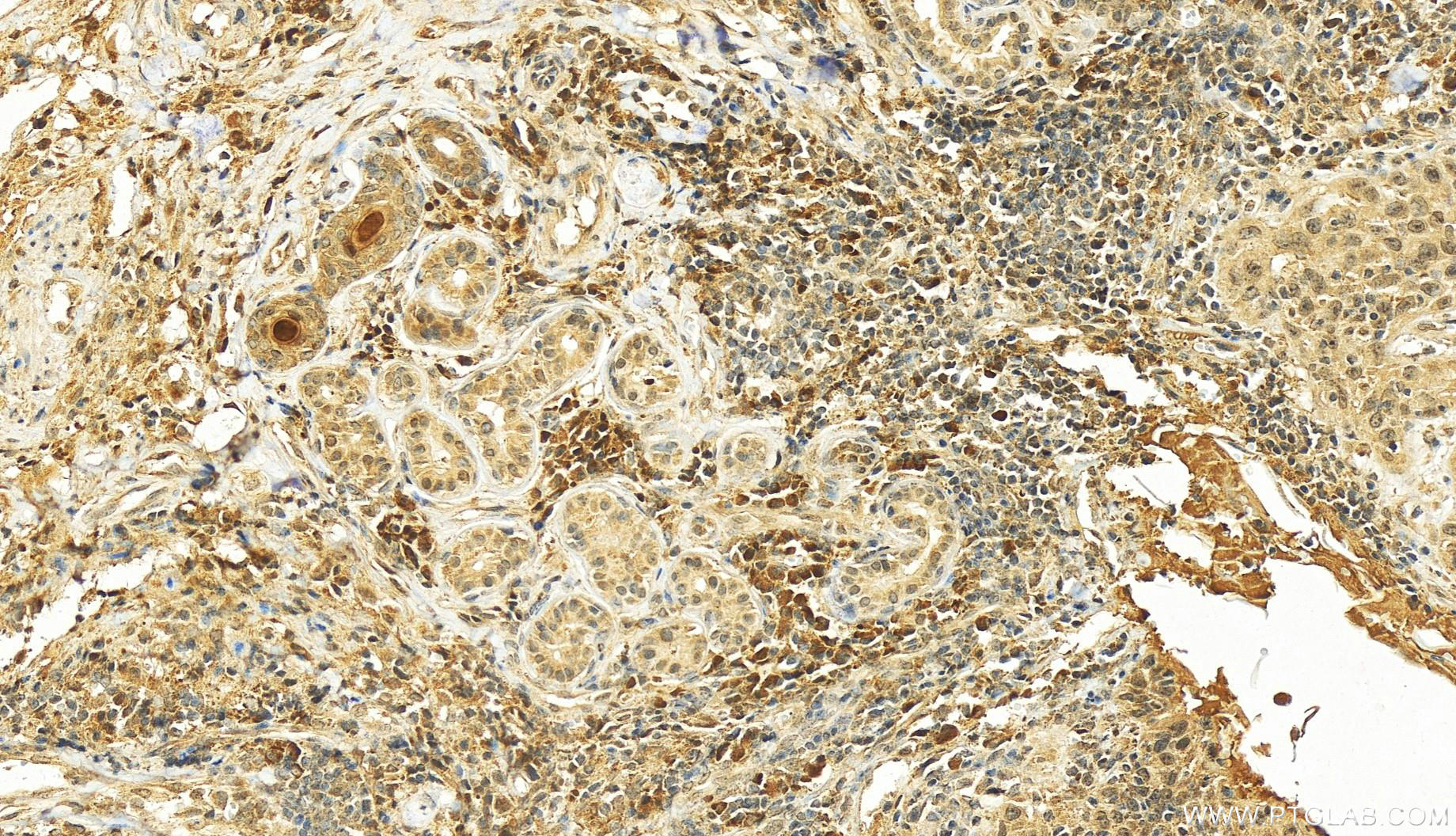 IHC staining of human skin cancer using 26754-1-AP