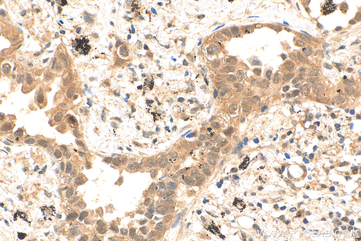IHC staining of human lung cancer using 28568-1-AP