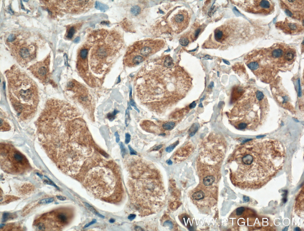 IHC staining of human breast cancer using 55341-1-AP