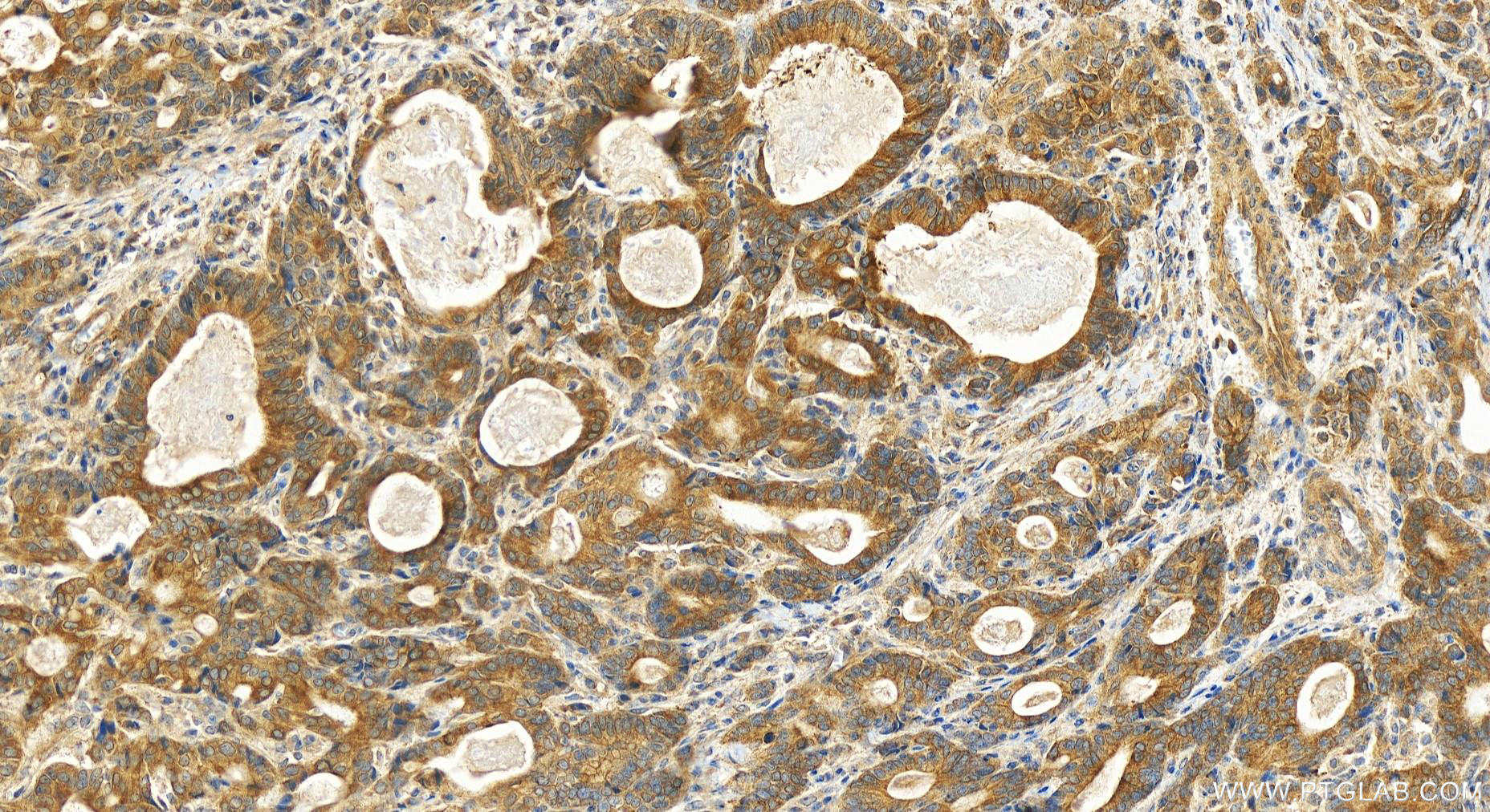 IHC staining of human stomach cancer using 14587-1-AP