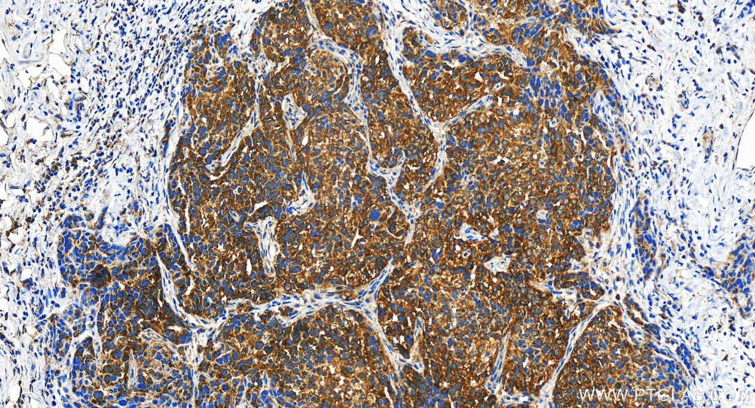 IHC staining of human ovary cancer using 21369-1-AP