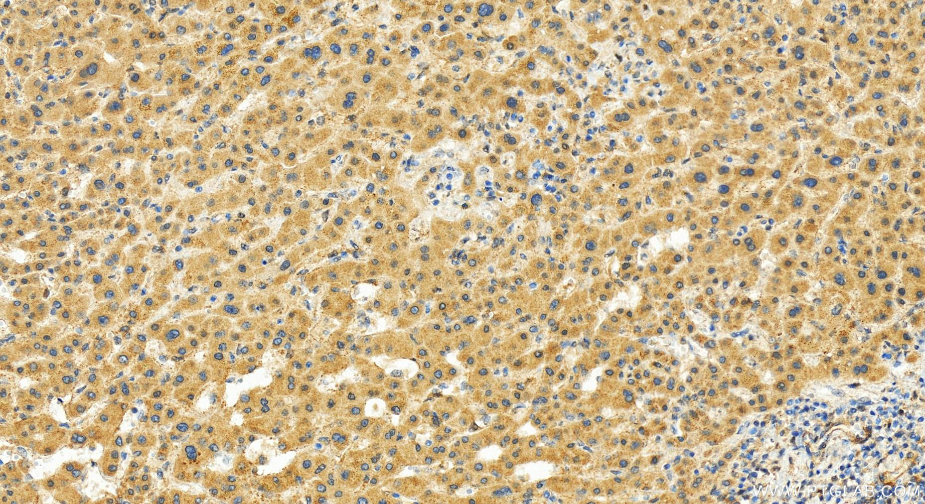 IHC staining of human intrahepatic cholangiocarcinoma using 27633-1-AP